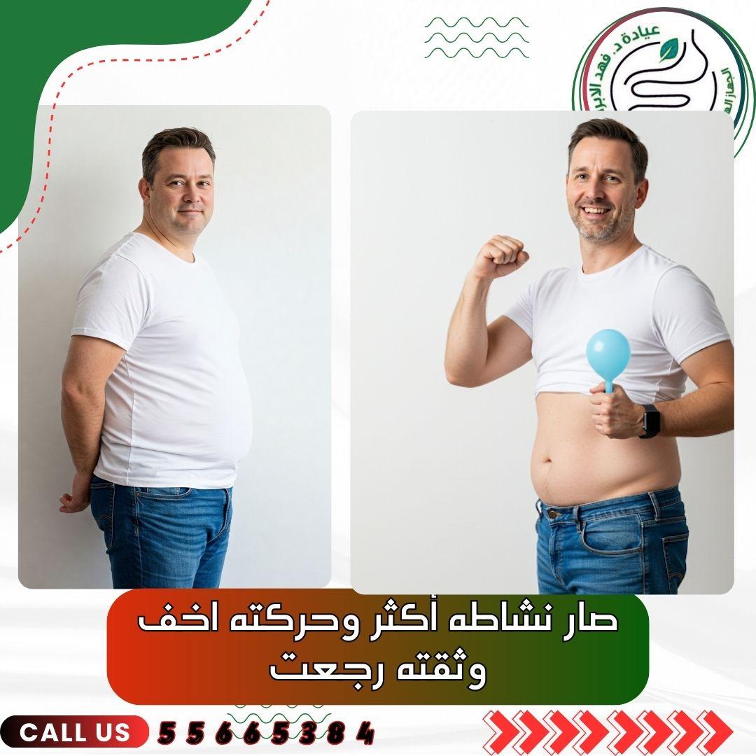 بالون المعدة مع د. فهد الإبراهيم – أفضل علاج للسمنة بالكويت