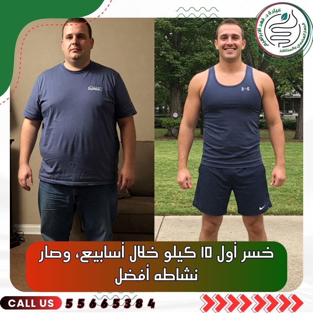 بالون المعدة مع د. فهد الإبراهيم – أفضل علاج للسمنة بالكويت