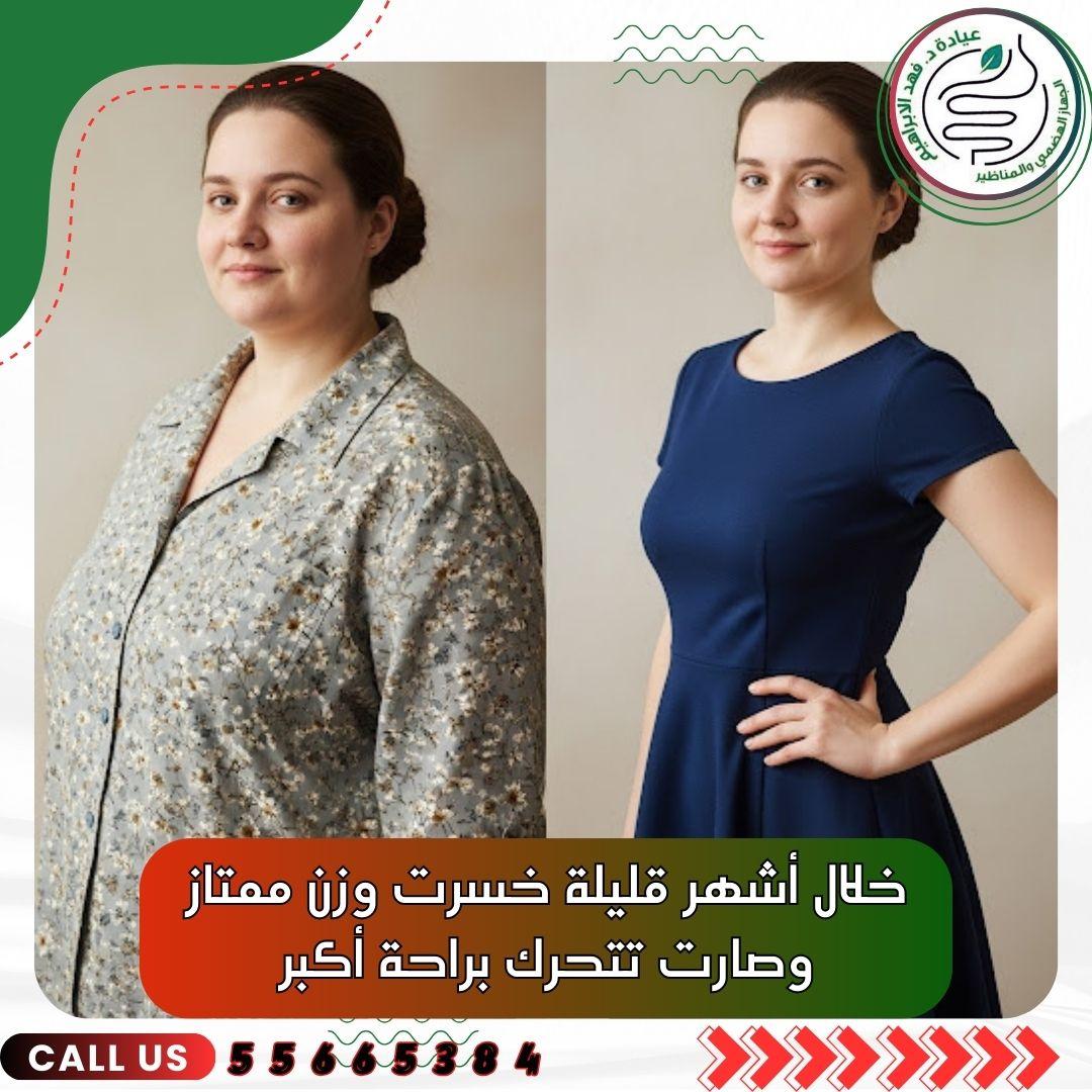 بالون المعدة مع د. فهد الإبراهيم في الكويت